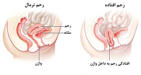 افتادگی رحم و بارداری، ایا افتادگی رحم باعث نازایی میشود، افتادگی رحم و بارداری مجدد،  ایا افتادگی رحم مانع بارداری میشود ، افتادگی رحم و نازایی،  افتادگی رحم در زایمان طبیعی،  افتادگی شکم در بارداری،  راه درمان افتادگی رحم،  درمان افتادگی رحم با گیاهان دارویی  